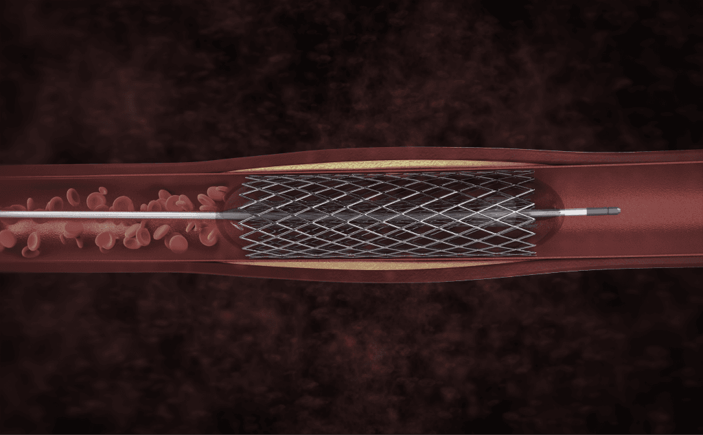 Peripheral Artery Disease